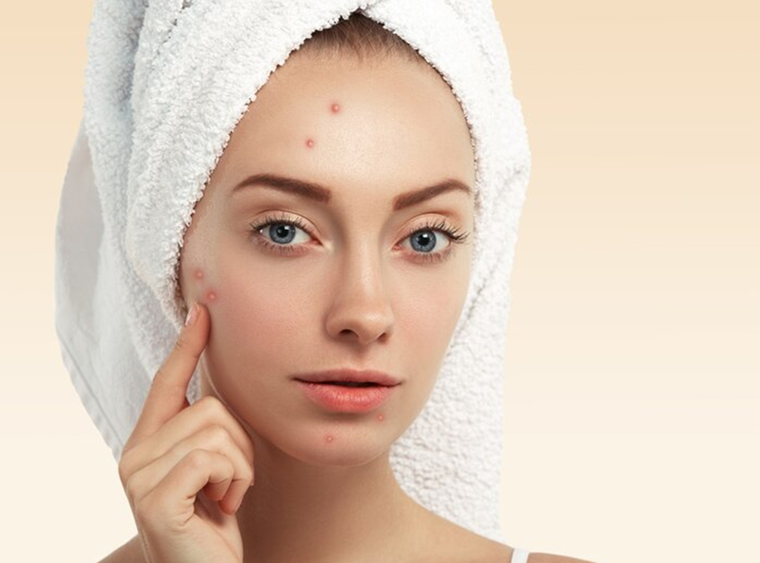 acne-treatment.jpg